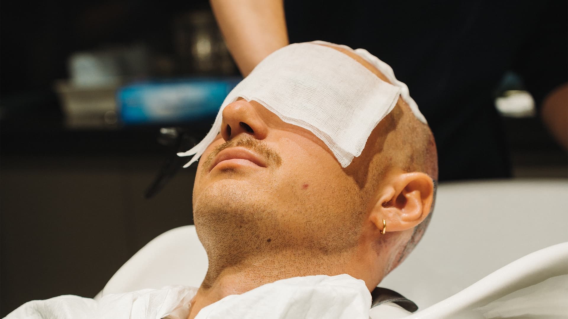 Aftercare efter hårtransplantation – måned for måned